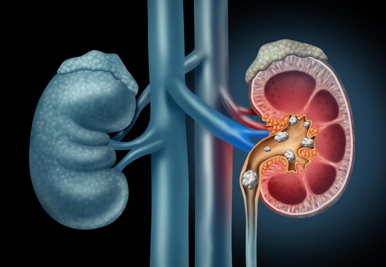 What Causes Kidney Stones (And What To Do) - Harvard Health