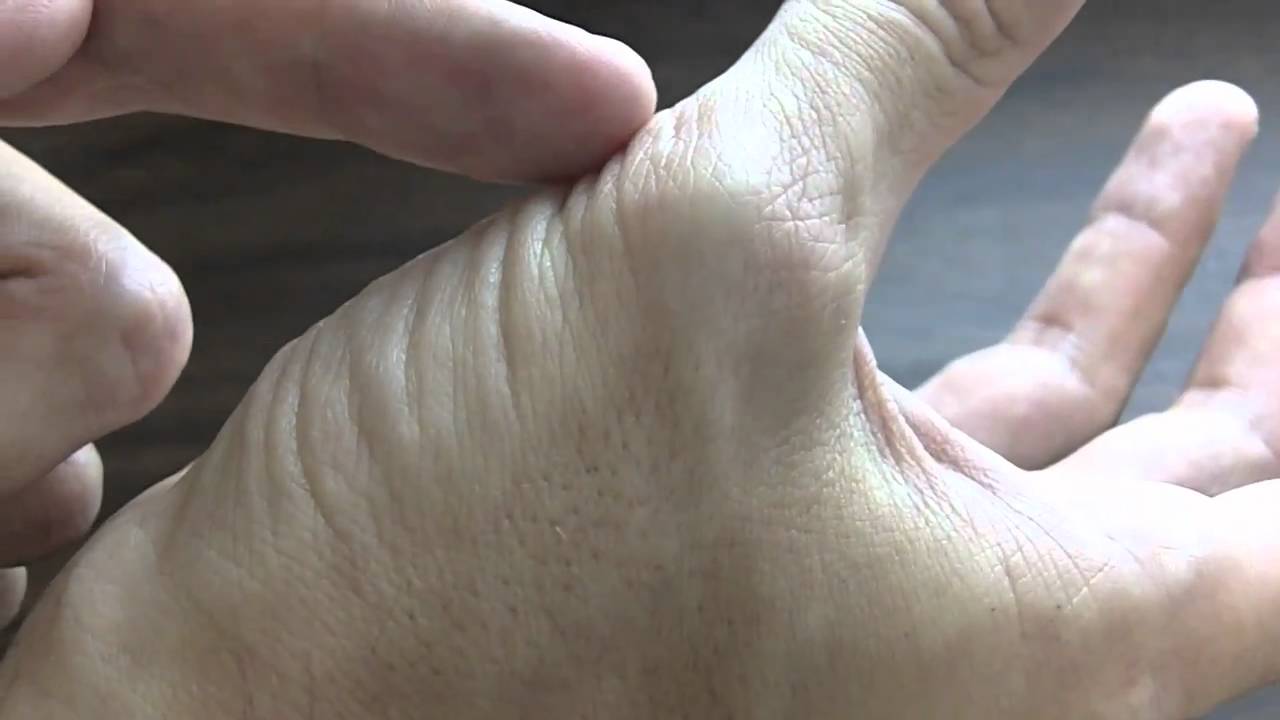 Thumb Muscle Atrophy – Carpal Tunnel Syndrome