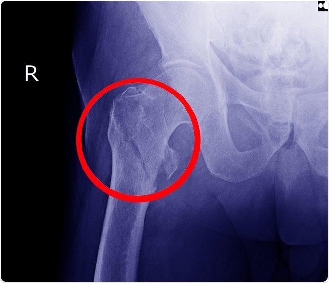 Experts Explain What Happens After Hip Fracture In Older Adults