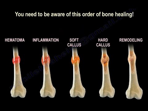 How Does Broken Bone Heal?